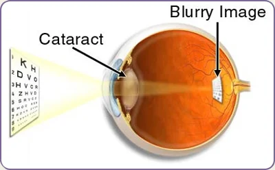 img-cataract.jpg