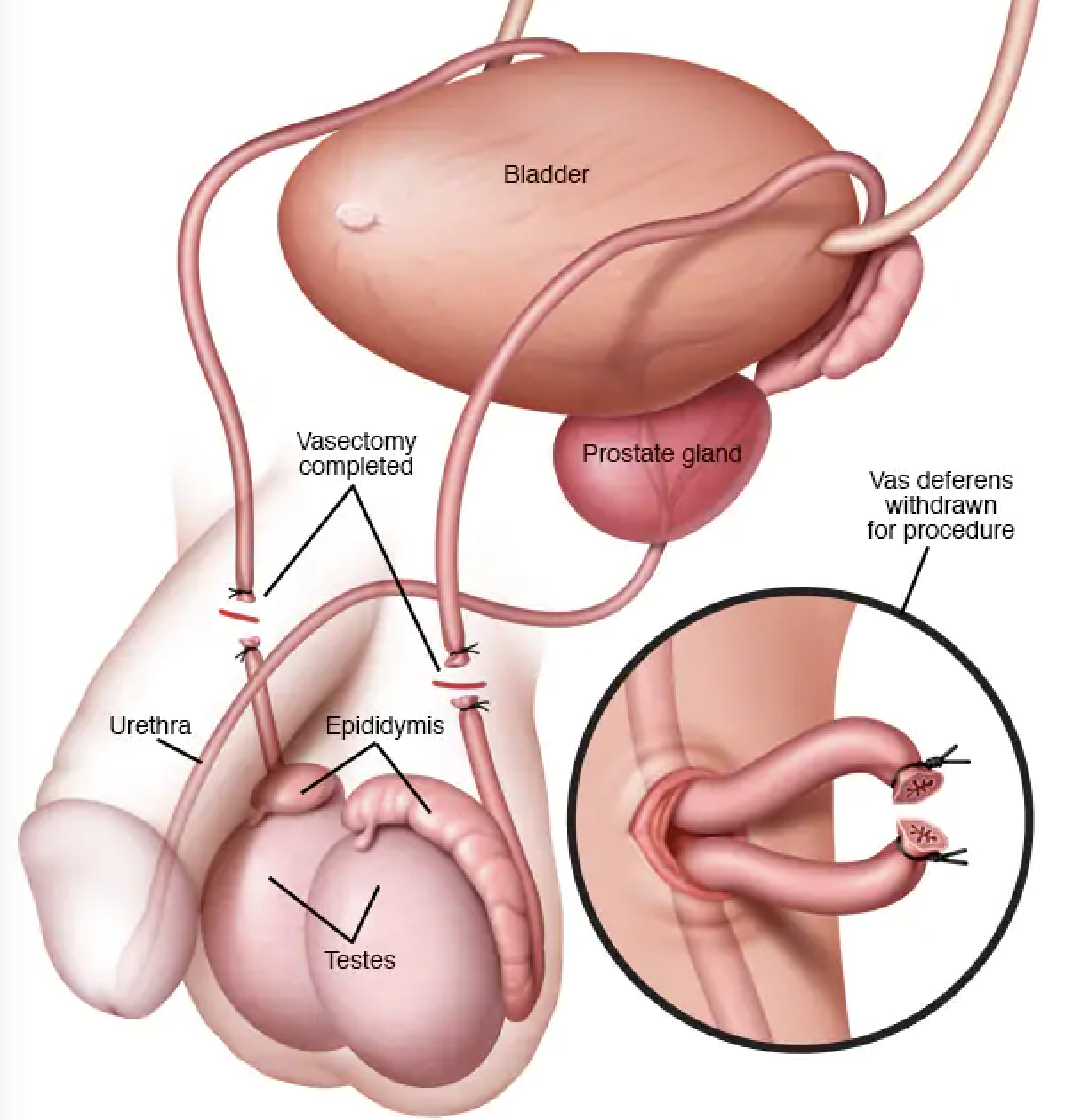 Vasectomy