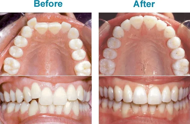 invisalign-before-after.jpg