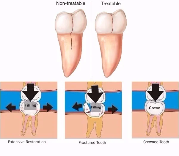 cracked-teeth.jpg