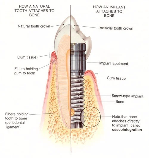 Implant%2Bsmaller.jpg