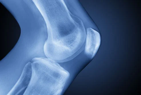getty_rm_photo_of_knee_xray.jpg