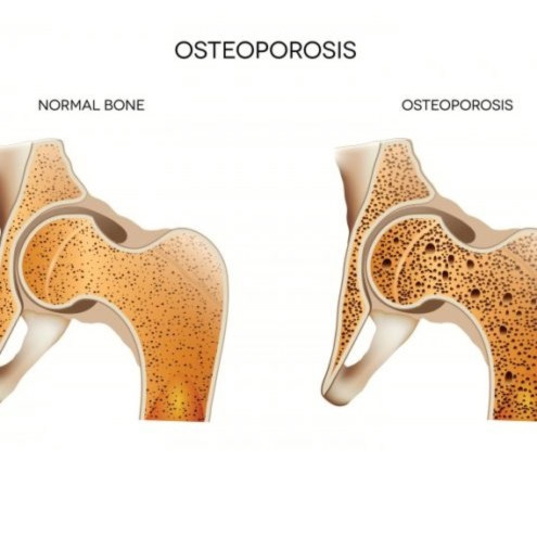 osteoporosis_hip_graphic.jpg