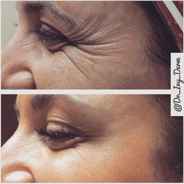 Comparison of an eye with deep wrinkles and a smoother skin appearance after treatment or skincare improvement.