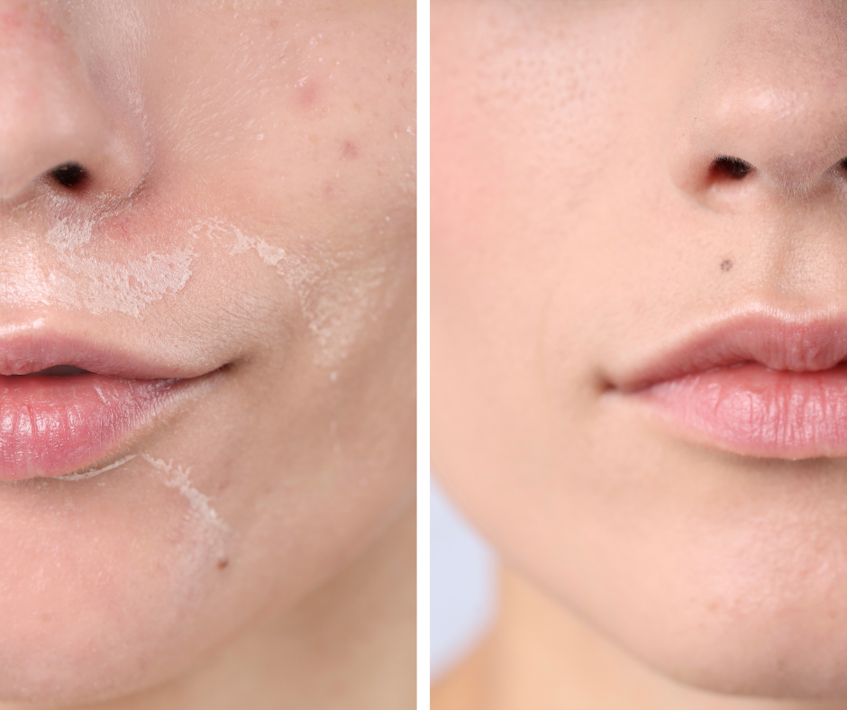 WHAT A CHEMICAL PEEL REALLY DOES FOR YOUR SKIN