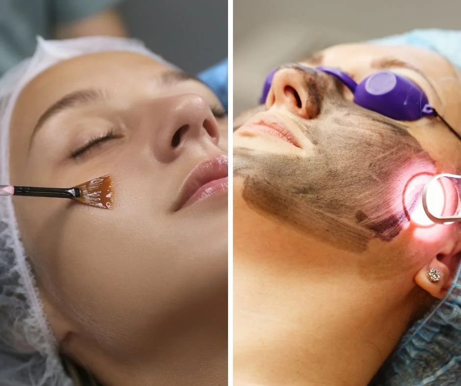 PEELS VS. LASERS