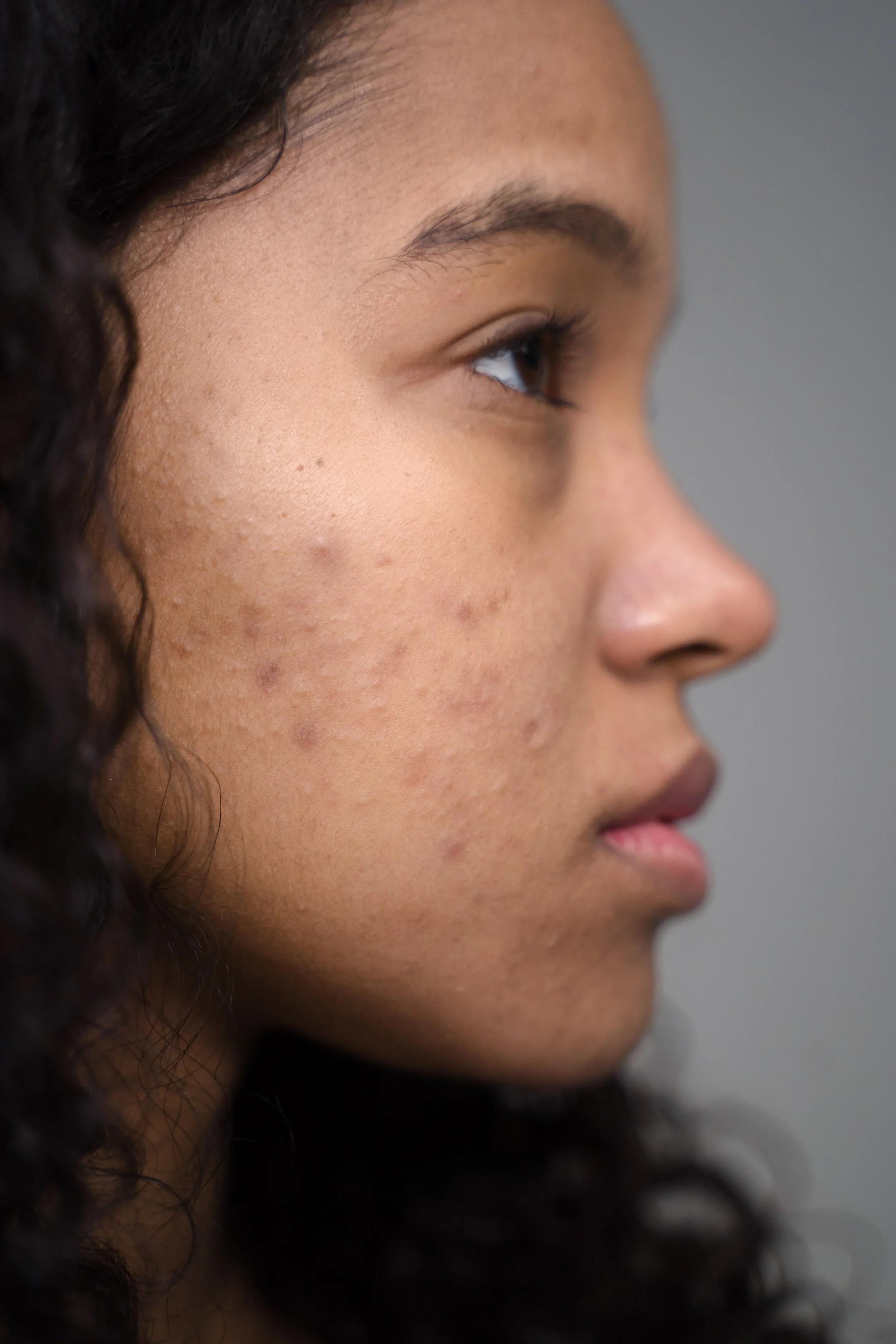 Specialized Hormone Testing for Acne in Bellevue, WA: Discover the Root Cause of Persistent Breakouts