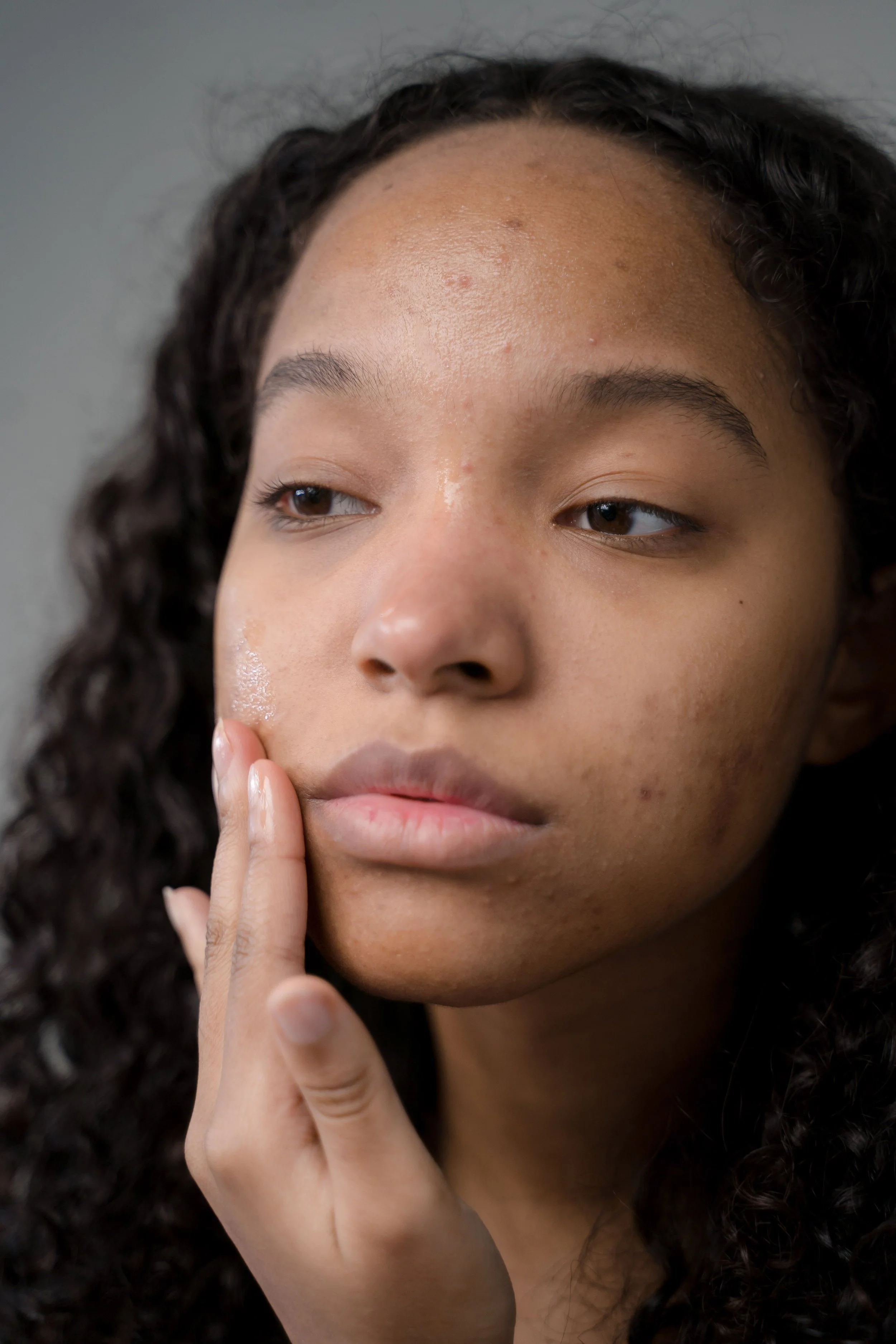 Acne: A Naturopathic Approach to Clearer Skin