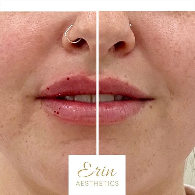 HALFWAY - #lipsbyerin 😍
.
.
Trick to achieving natural lips is to build 🙌
.
.
.
 #lipsbyerin #fullfacetransformationbyerin #cheeksbyerin #jawlinebyerin #wrinklerelaxersbyerin #erinsangels #musclerelaxantsperth #wrinklerelaxersperth #lipsbeforeandaf