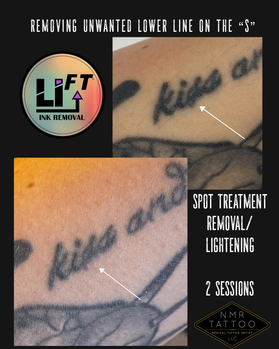 LiFT  Saline Tattoo Lightening