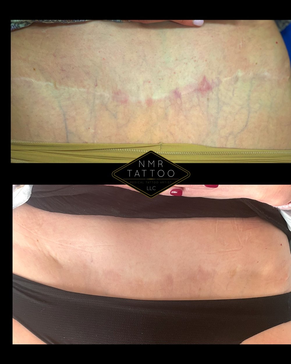 Dry Tattooing Dry Tattooing