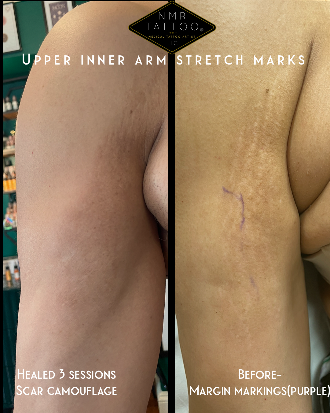 Best Scar Camouflage with medical tattooing in UK by registered nurse