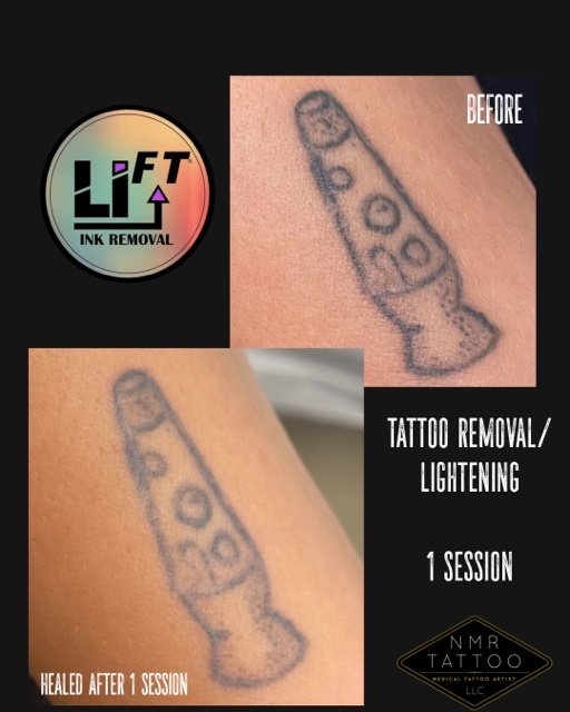 Best Laser Tattoo Removal Long Island NY 11030  Tattoo Removal Near Me   Laser Tattoo Removal Near me  Tattoo Removal Manhasset  Tattoo Removal NY  11030  Tattoo Removal Long