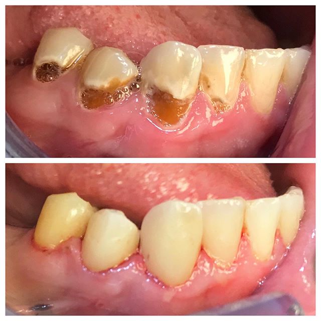 Pictured above is a before and after of quadrant cavity repair and restoration performed by Dr. Reihner. If your smile needs a makeover, call our office today! 🦷 (304) 232-5101 #cavity #decay #dentist #wheelingdentist #wheelingwv #smilemakover