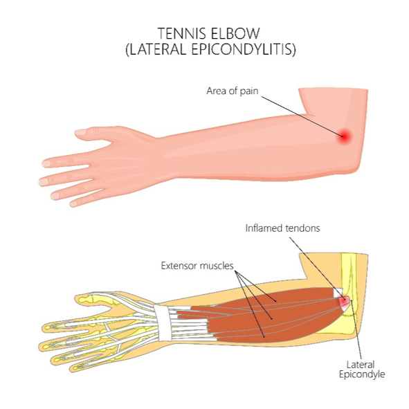 Tennis Elbow.png
