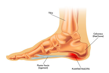 Growing Pains in the Heel — Brookvale Physio | HPRS Physio