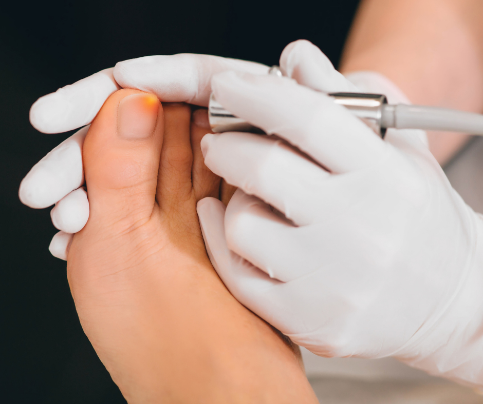 laser toe therapy