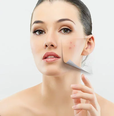 acne-acne-scarring.jpg