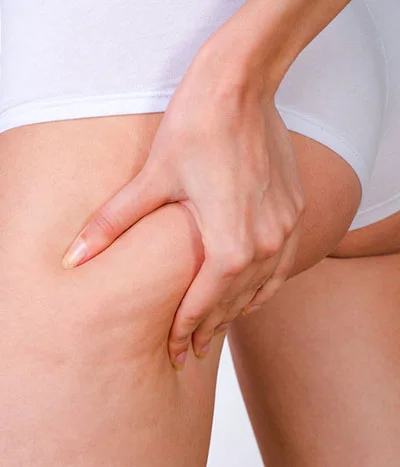 cellulite-treatment.jpg