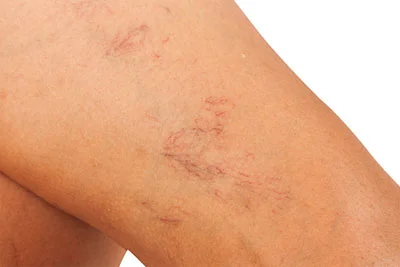 spider-veins-treatment.jpg