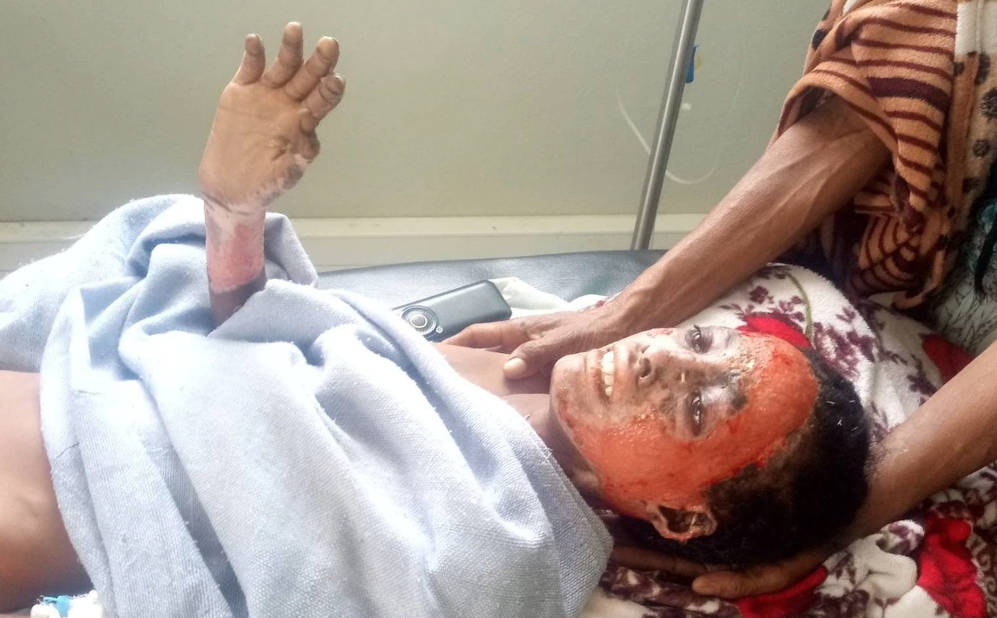 Ethiopians suffer horrific burns in suspected white phosphorus attacks