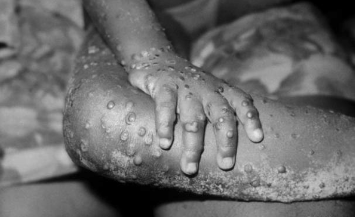 Suspected monkeypox probed in Morocco and Sudan