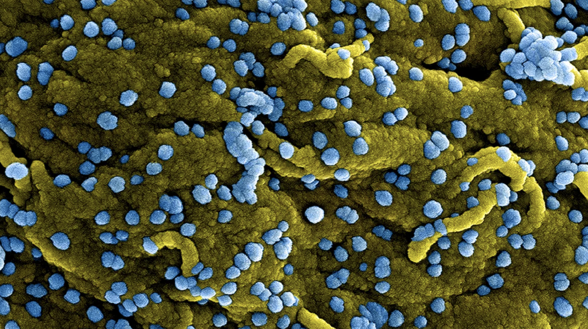 Rwanda is dealing with its first outbreak of deadly Marburg virus disease