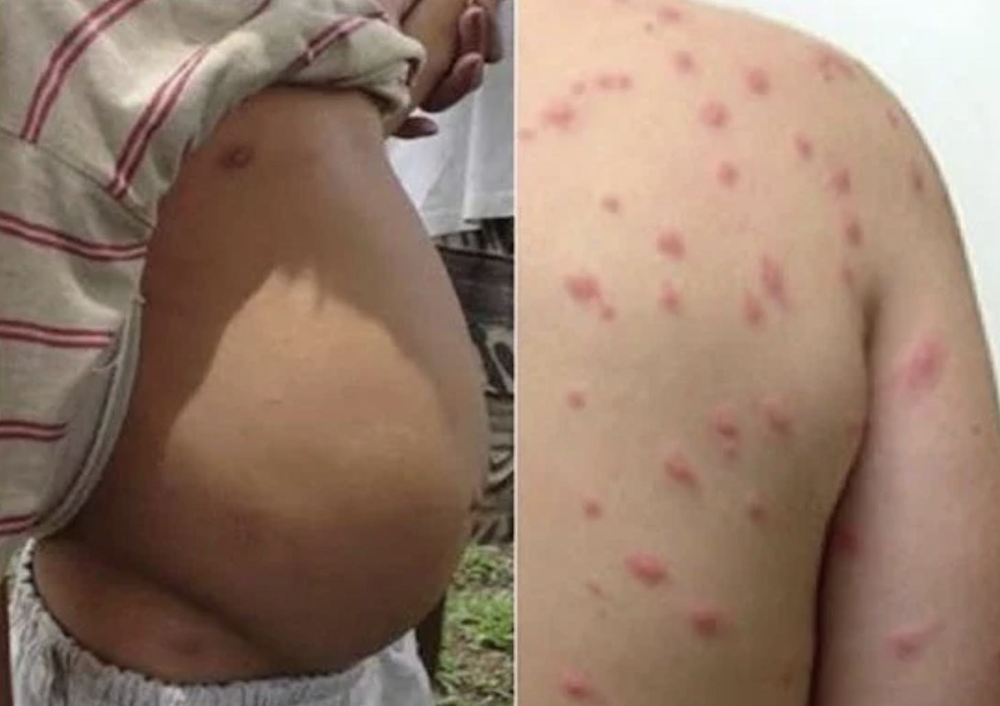 Tanzania: Over 81,000 Children to Benefit From Worm, Schistosomiasis Treatment in Ukerewe