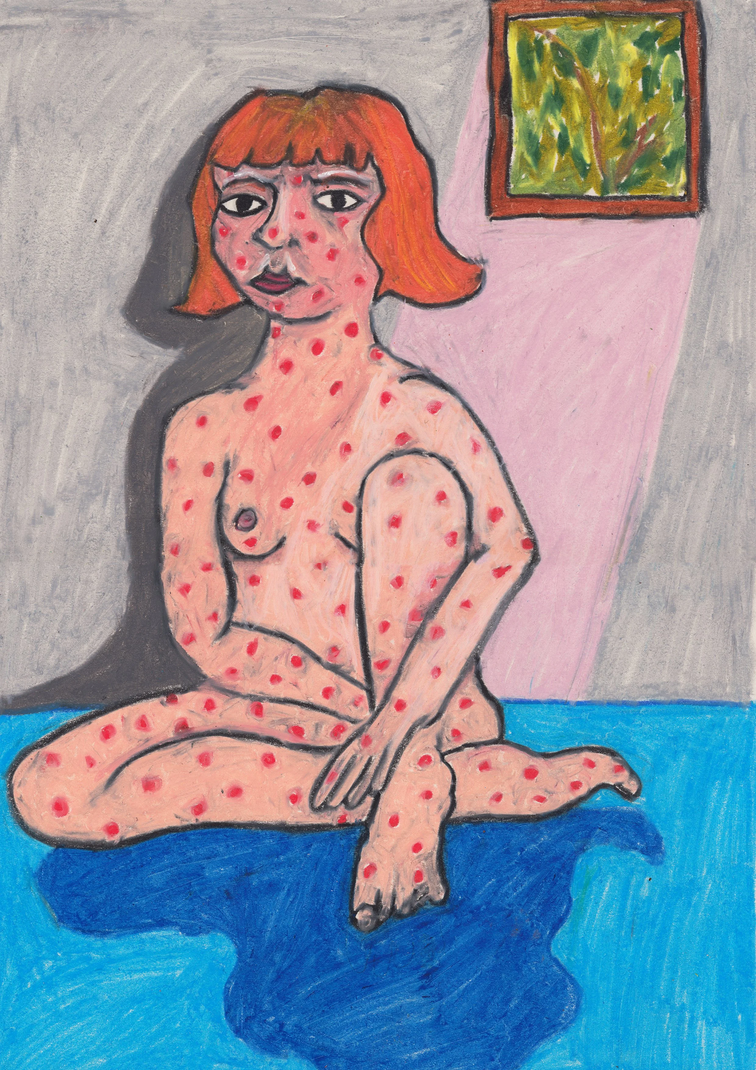 'Measles Sitting' Original Drawing