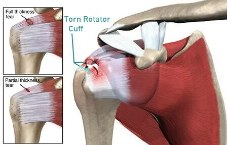 The Shoulder and Rotator Cuff Tears | Restore Function Physiotherapy