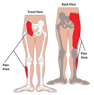 SI Joint Sprain/Pain/Dysfunction — Perth Sports Chiropractor | Inglewood WA SI Joint Sprain/Pain/Dysfunction — Perth Sports Chiropractor | Inglewood WA