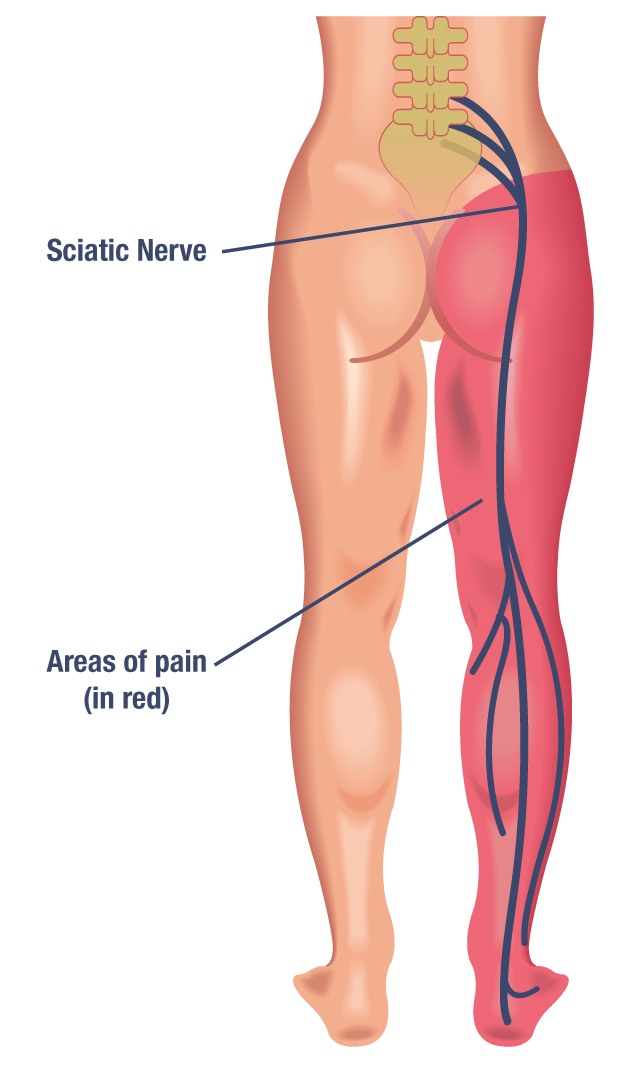 Sciatica walking with limp