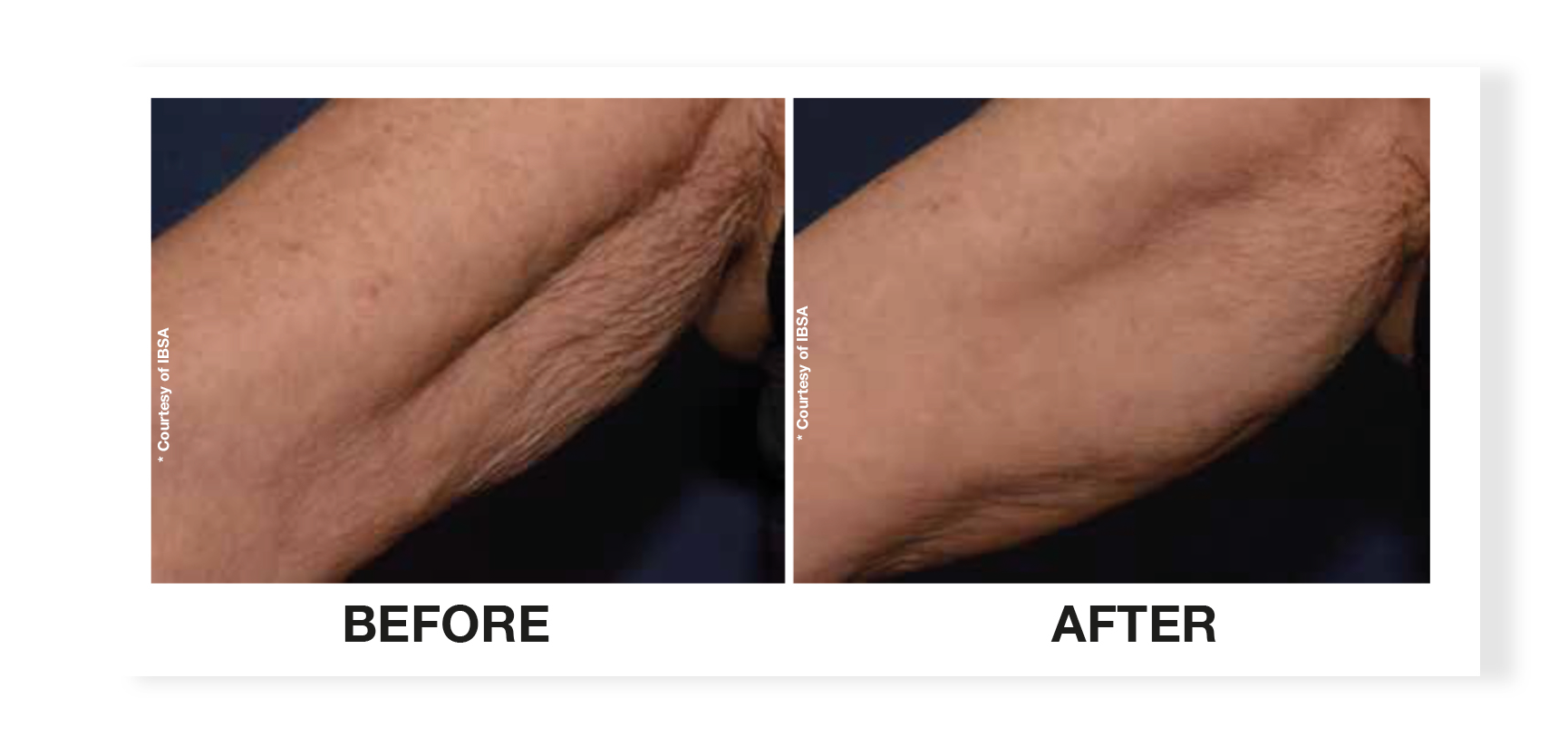 Profhilo injection treatment