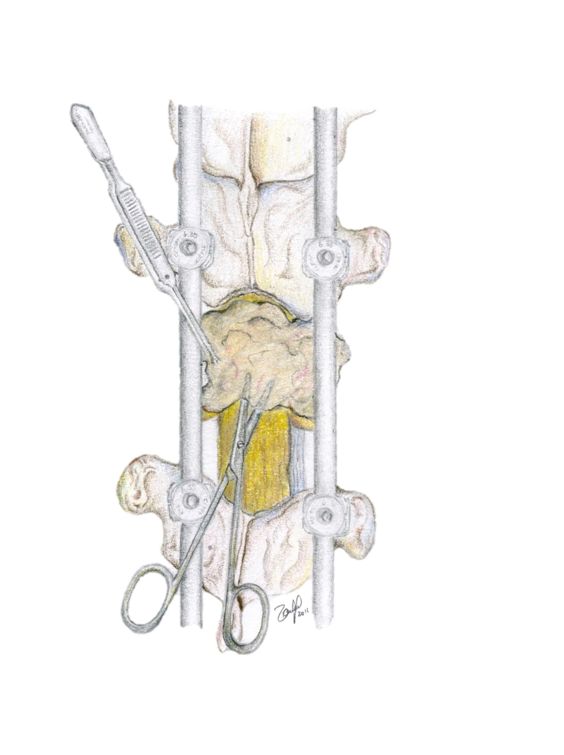 Separation Surgery