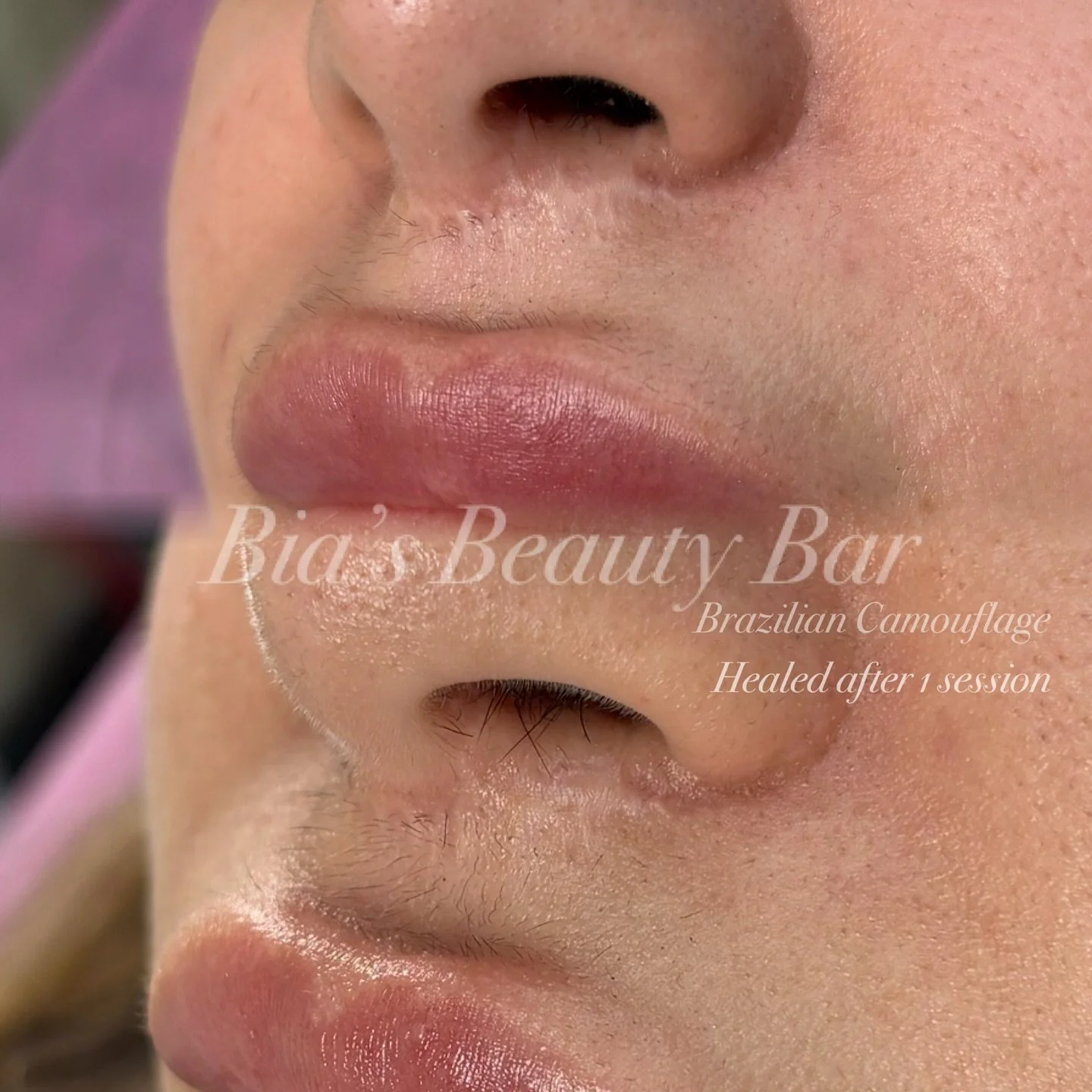 6 weeks after the first session these are my clients beautifully healed results. Unfortunate due to breaking up a fight she had to get stitches on this area. I treated her to a second session and cannot wait to see her healed results! 

If we haven&r