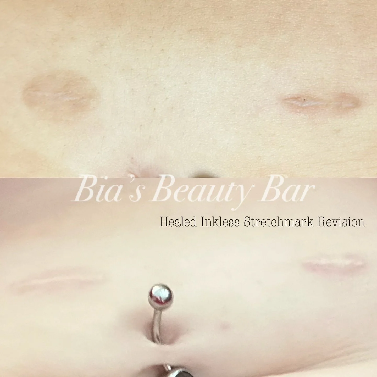 Let&rsquo;s discuss healing 👇

Inkless Scar Revision/Stretchmark Revision is a game-changer, but the healing journey can be a wild ride! Initially, you may experience redness, inflammation, and if you have dark scars, they may appear to temporarily 