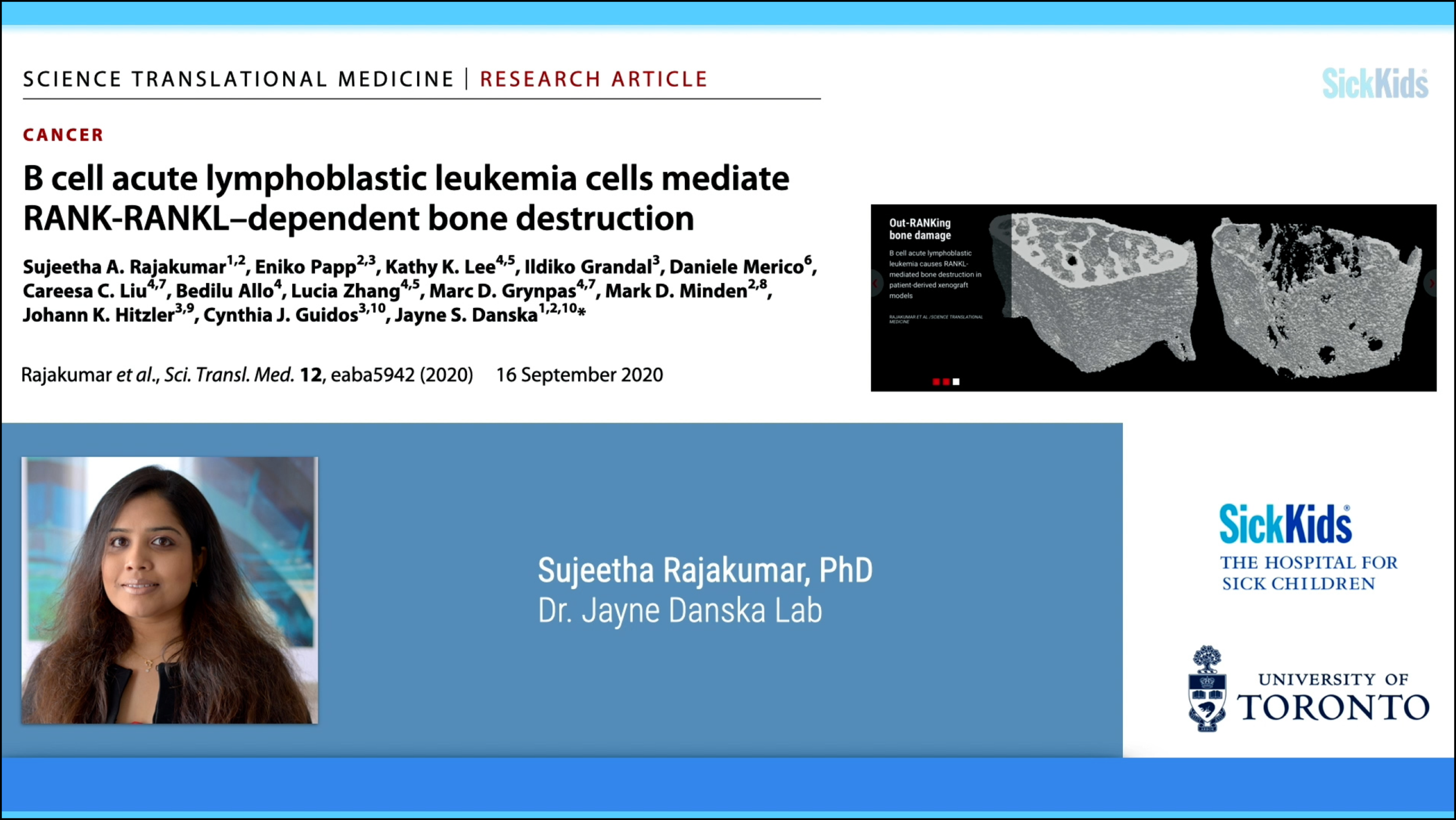 B cell acute lymphoblastic leukemia cells mediate RANK-RANKL-dependent bone destruction
