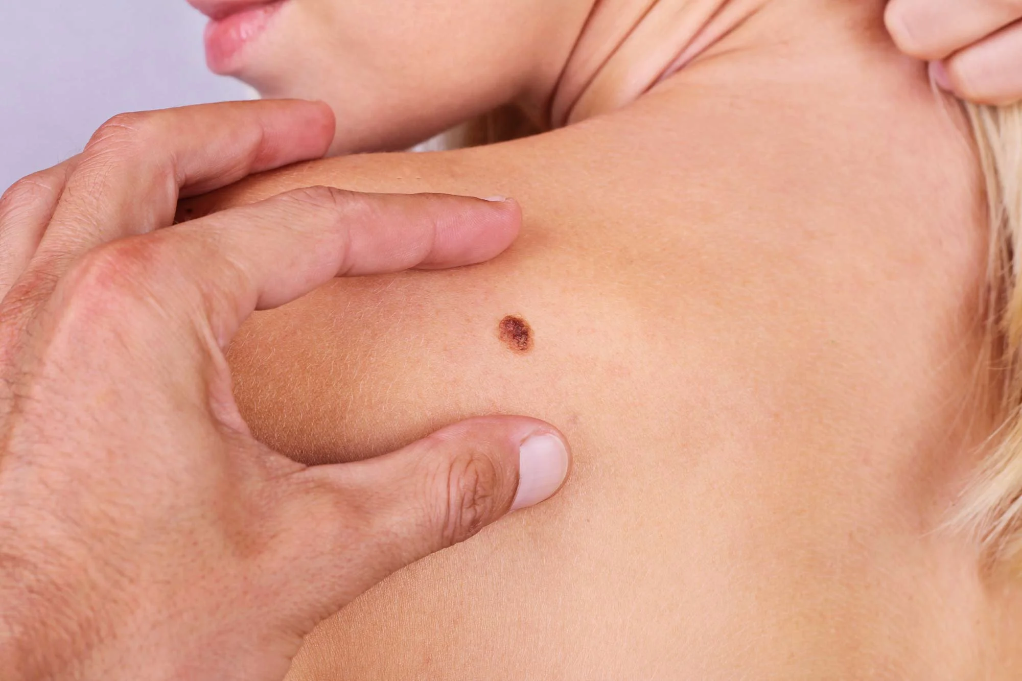 melanoma.jpg