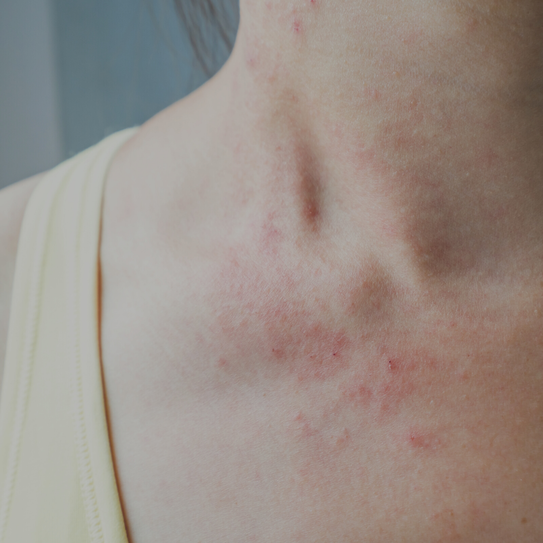 December Types Of Eczema And How To Manage Your Eczema — Dermatology Of