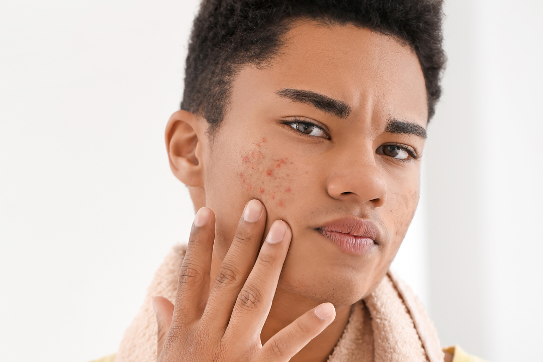 Is it Acne or Rosacea? — Dermatology of North Asheville