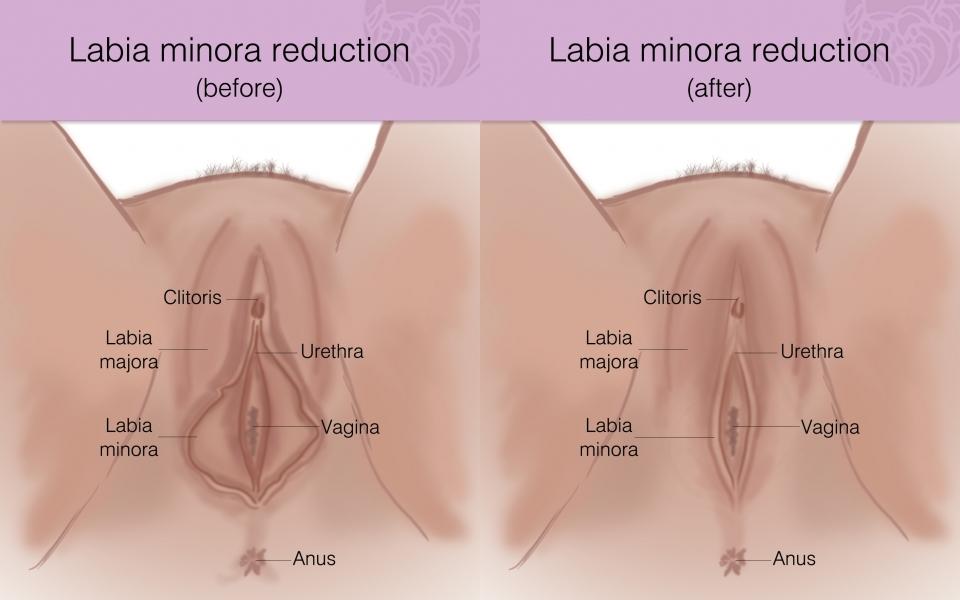 labia surgery