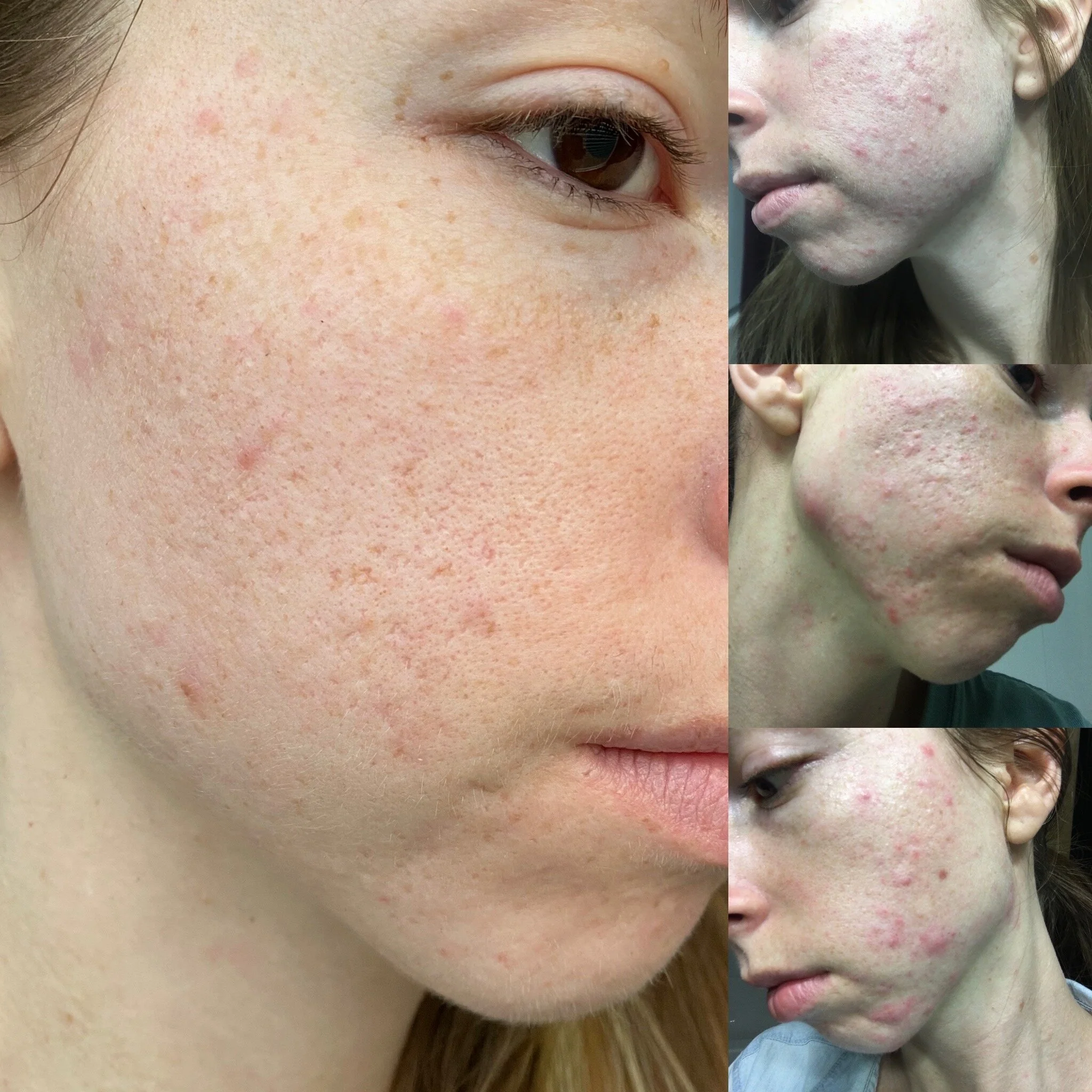 My Acne Transformation Journey