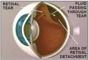 retinal-detachment-1.jpg
