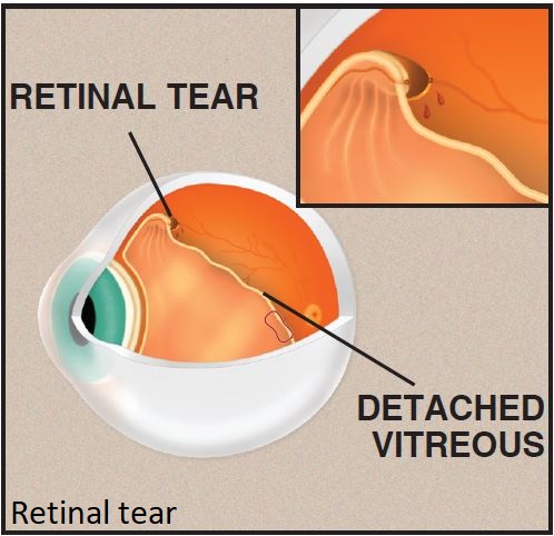 tear1.jpg