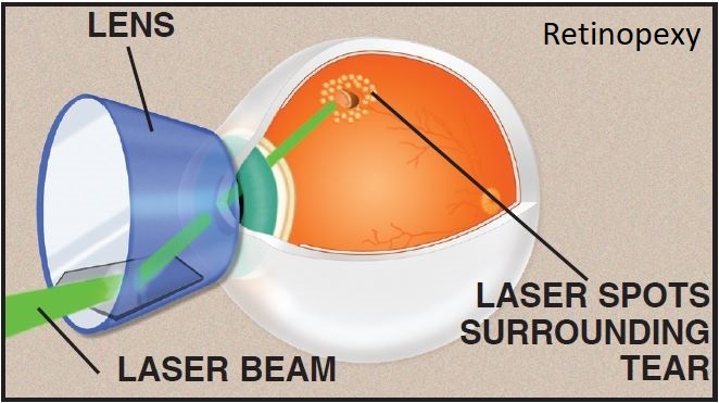 retinopexy2.jpg