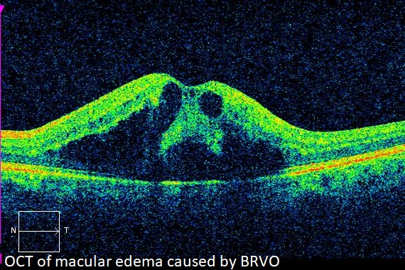 OCT BVO before.jpeg