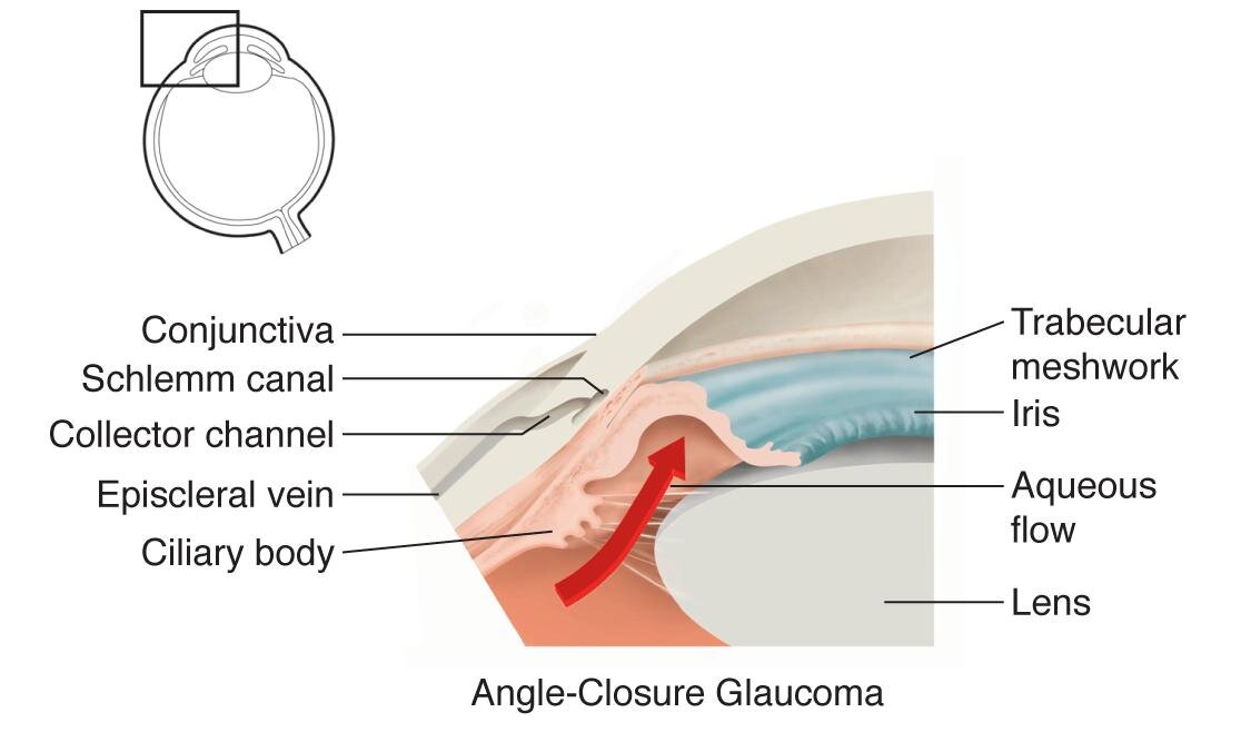 angle closure.jpg