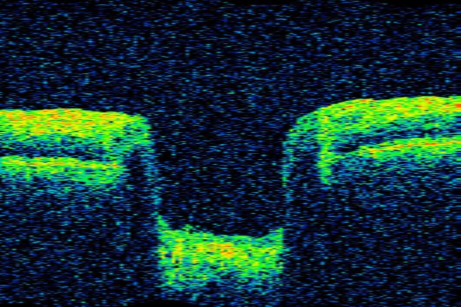 OCT of the optic nerve showing cupping of the disc