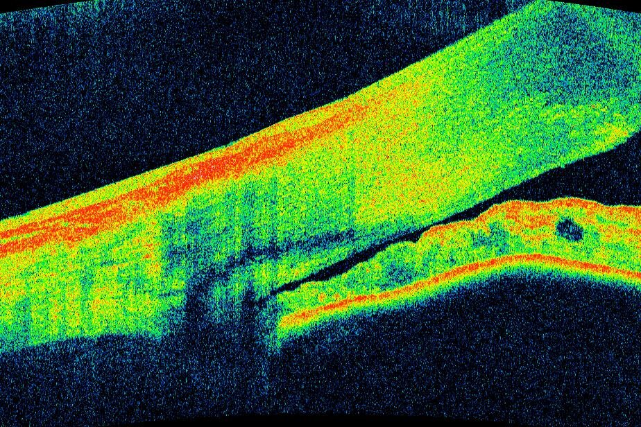 OCT of the anterior chamber showing a closed angle structure