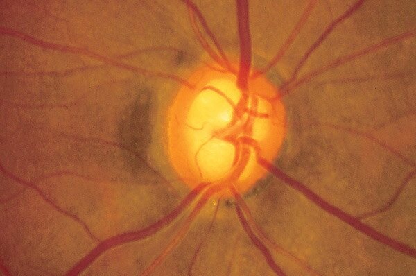 Fundus photo of the optic nerve